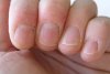 nails-signals-systemic-disease-1.jpg